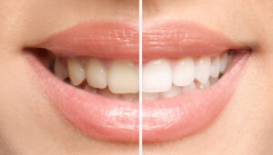 teeth-whitening