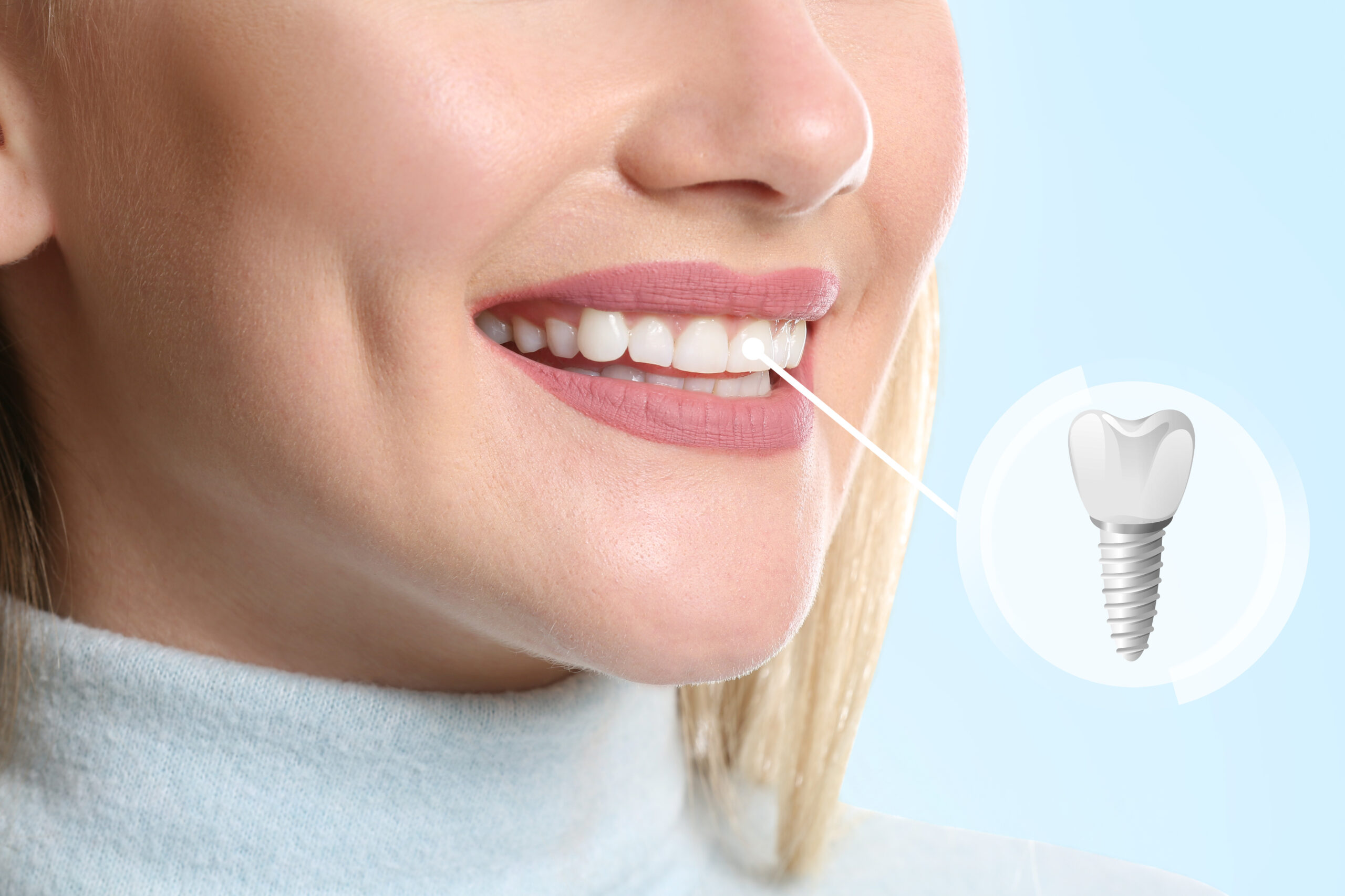 Featured image for “Affordable Dental Implants in Mississauga, ON”