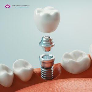 dental implants mississauga